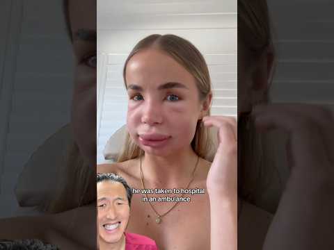 Her Lip Filler was Melted… Then This Happened!
