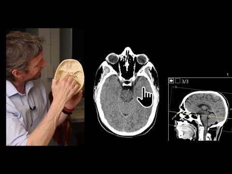 Paranasal sinuses CT imaging anatomy