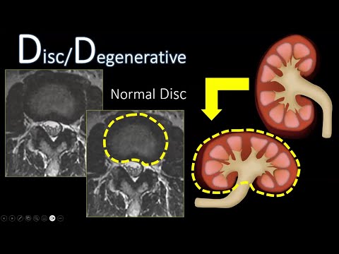 The ABC's of Degenerative Spine Imaging - Neuroradiology Longitudinal Course Sample