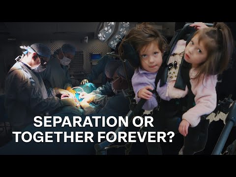 The Heartbreaking Choice of Separation | Extraordinary Twins (4K Documentary)