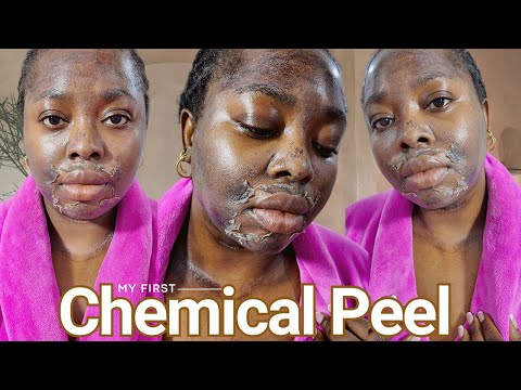 My First CHEMICAL PEEL Procedure | Full Process, Skin Shedding, Before & After + Review