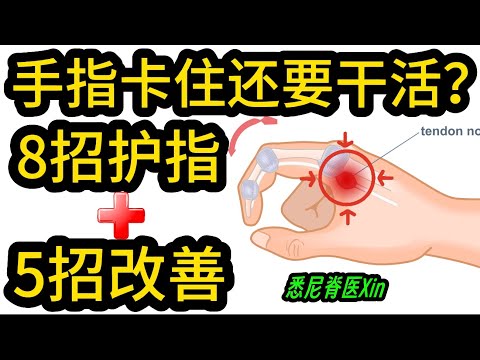 手指卡住还要上班？8个护指技巧＋5个自救动作，让板机指快速康复！｜悉尼脊医Xin