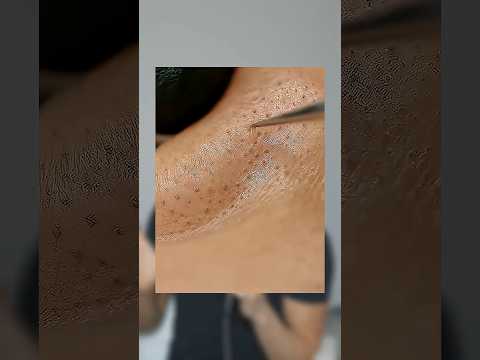 How to prevent blackheads from forming 😲