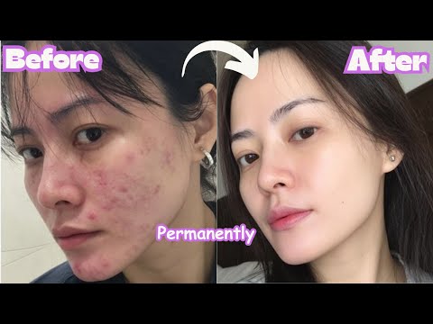 Easy Ways to Fade Hyperpigmentation for Good