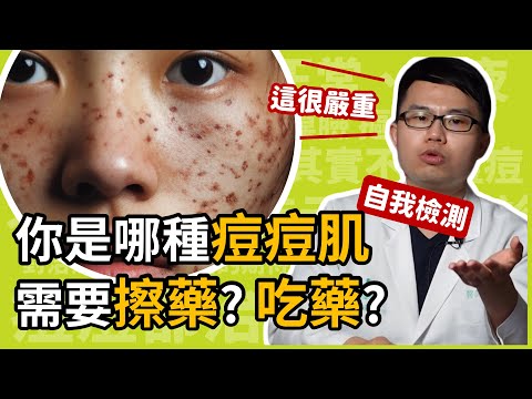 你是哪種痘痘肌?長兩顆痘痘算嚴重?應該吃藥、還是擦藥呢?皮膚科楊省三醫師教你自我檢測痘痘嚴重程度!