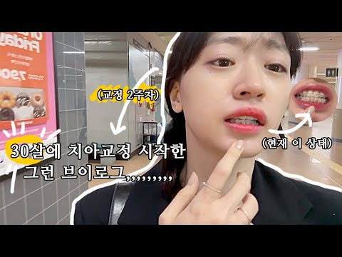 30살.... 치아교정 시작한 그런 브이로그.....