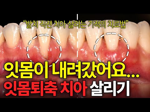 내려간 잇몸 치아 빼지 않고 치료할 수 있습니다 l 잇몸퇴축 최신 치료법