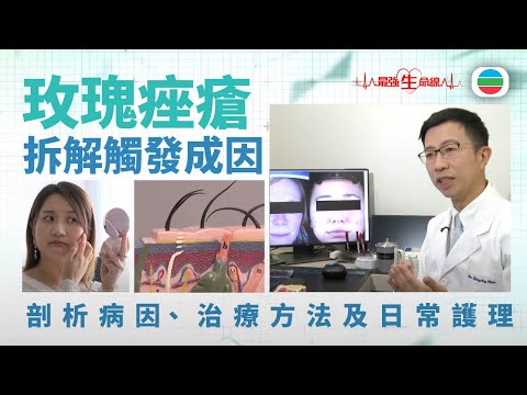 最強生命線｜玫瑰痤瘡：深入剖析病因、治療方法及日常護理 (繁 / 簡字幕)｜醫療｜治療｜無綫新聞｜TVB News