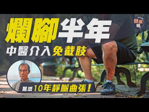 爛腳半年險截肢 10年靜脈曲張懵然不知 中醫介入方痊愈｜正確認識靜脈曲張6階段｜2動作預防舒緩｜健康嗎@HealthCodeHK【醫檔案】#靜脈曲張 #varicoseveins