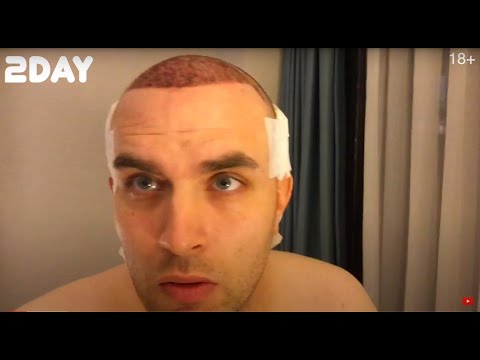Hair Transplant from Day 1 to Day 365, Evolution of Hair Transplant 2021!