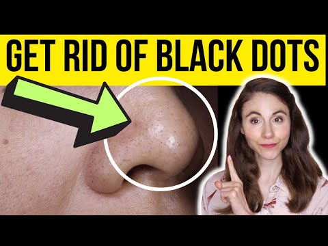 HOW TO GET RID OF BLACK DOTS ON THE NOSE | Dermatologist