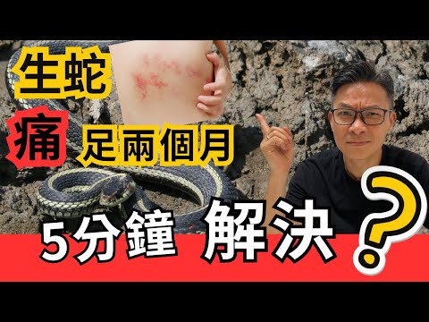 突然生蛇，健康警號，教你預防！5分鐘立即止痛激活免疫，扶正身體，解決兩個月痛苦 ? #生蛇 #帶狀疱疹 #中醫針灸 #艾灸 #註冊中醫師張桂鴻博士
