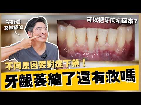 【牙齒保健 #9】牙齦萎縮是不是回不去了？牙齦還有可能自己長回來嗎？牙齦萎縮可以依靠牙齒矯正來補救嗎？【醫師說重點】｜【祐民牙醫－隱適美旗艦店】鑽石級楊大為醫師