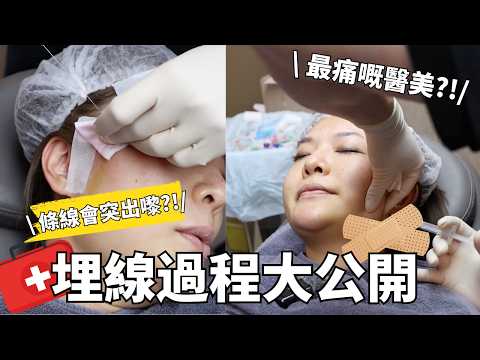 🧐「最痛醫美」埋線有幾痛？第一身過程大公開‼️| 成效顯著值得做？醫美療程真實分享 | Yoyo Yip MakeUp