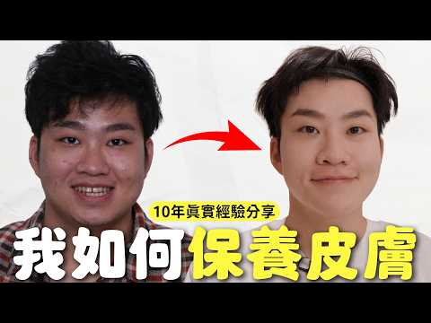 我10年痘痘爛臉的抗痘心得 !【Joeman】