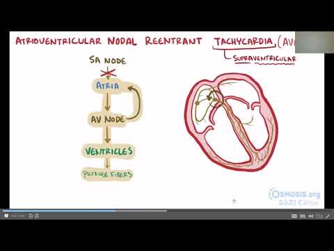 AVRT and AVNRT