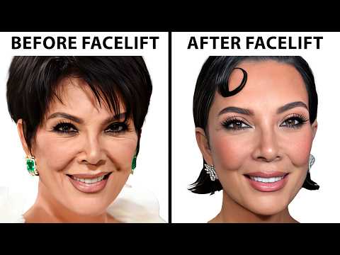 Facelifts Have Changed... Here's How