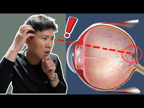 80% 的視網膜病變都是這一個原因造成的 (飛蚊症, 視網膜裂孔/剝離)