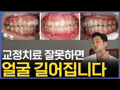 치아교정 후 길어진 얼굴 왜 그럴까?