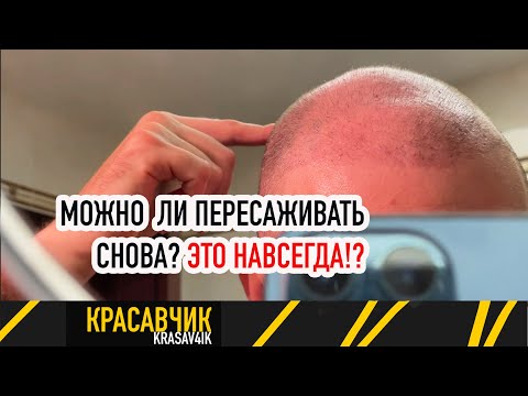 2 месяц после пересадки волос: надолго ли это? Насколько они крепкие  / КРАСАВЧИК