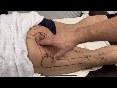 Триггеры в грушевидной мышце. Боль в ноге.Ишиас.Седалищный нерв.#триггеры #боль #седалищныйнерв