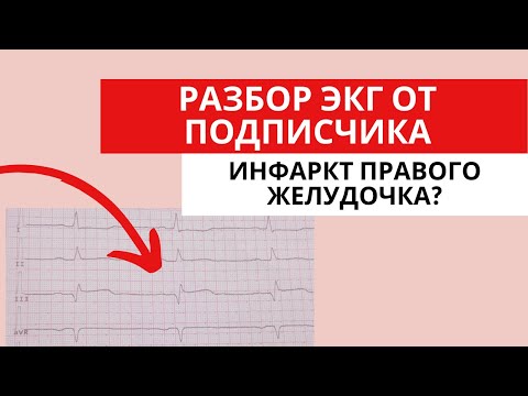 Разбор ЭКГ от подписчика. Инфаркт правого желудочка? (Острый коронарный синдром)