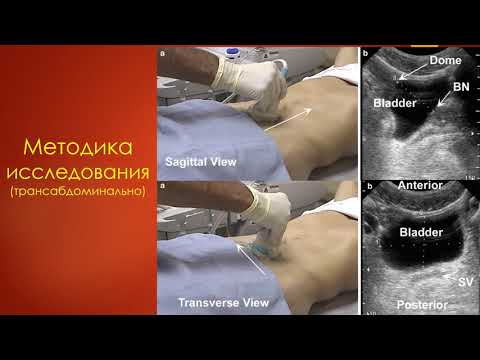 УЗИ мочевого пузыря. Станислав Феданов.