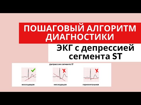 Причины депрессии сегмента ST? Как их отличать друг от друга? Дифференциальная диагностика.