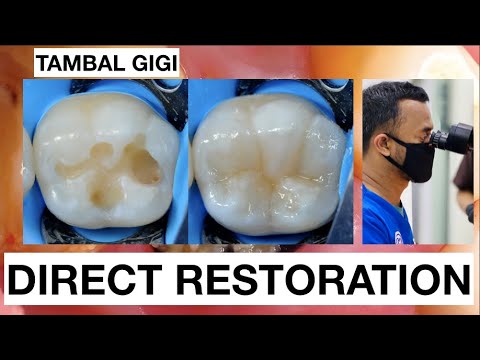 Step by step Filling Composite Lower Molar Direct Restoration Class I | General Dentist Griya RR