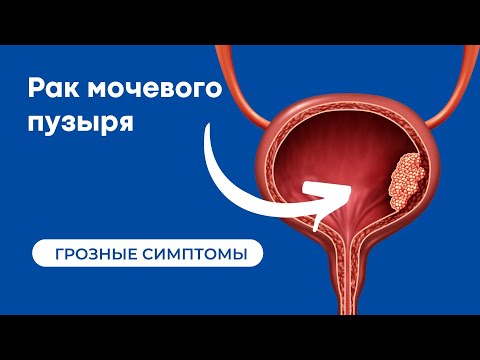 Симптомы рака мочевого пузыря | Что делать если в моче кровь
