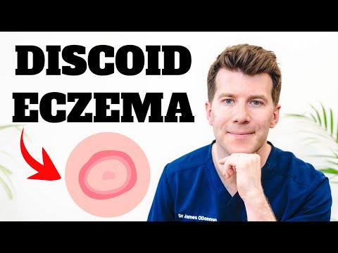 Doctor explains Discoid Eczema | Causes, Symptoms, Photos and Treatment