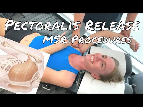 Pectoralis Release - MSR Procedures