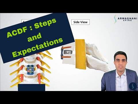 ACDF (Anterior Cervical Diskectomy and Fusion) - What is it? How do you do it? What can I do after?