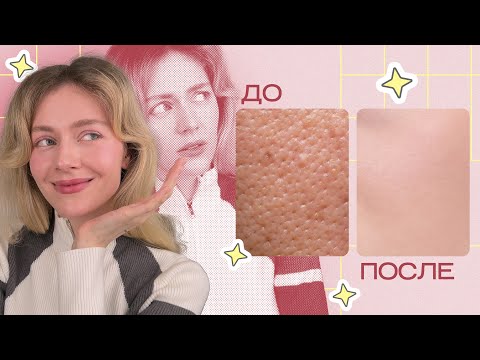Как избавиться от РАСШИРЕННЫХ ПОР и КОМЕДОНОВ навсегда