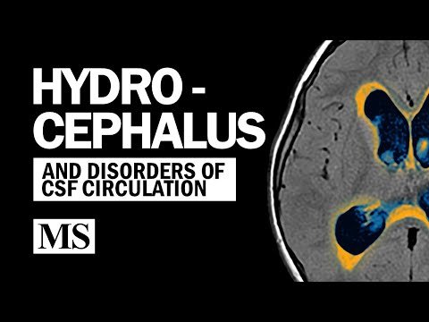 Hydrocephalus And the Disorders of CSF Circulation
