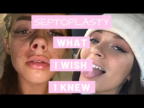 How To Survive A Septoplasty | What I Wish I Knew