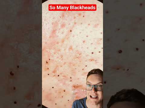 Amazing BLACKHEAD REMOVAL - So Many Blackheads #shorts