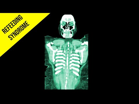 The Woman Who Ate 23 Bananas After Fasting 7 Days And Had Refeeding Syndrome