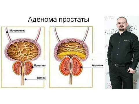 Как лечить аденому простаты?