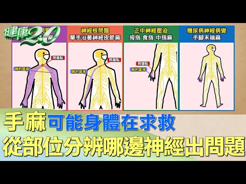 手麻可能身體在求救 從部位分辨哪邊神經出問題 健康2.0
