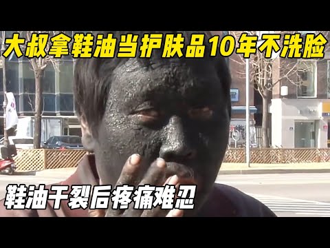 Uncle uses shoe polish for skincare  applies daily  unwashed for 10yrs  face pain after crack.