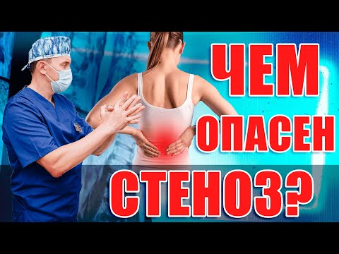 Стеноз, какие последствия не лечения? Ответы на вопросы