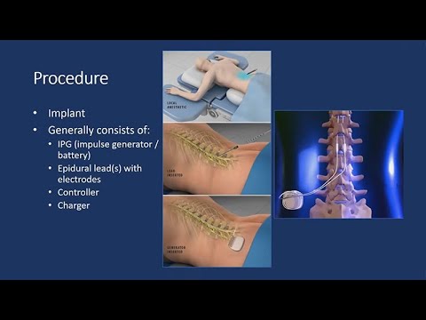 The Future of Back Pain Management