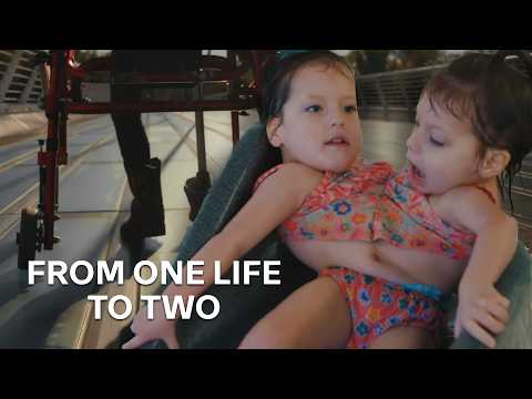 Separation Surgery or Together Forever? The Dilemma of Conjoined Twins | Extraordinary Twins