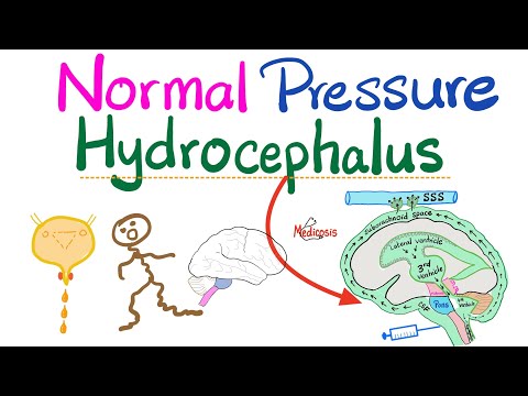 Normal Pressure Hydrocephalus (NPH) - Urinary Incontinence, Ataxia, Dementia (memory loss) - Neuro