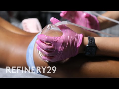 I Got A Non-Surgical Butt Lift | Macro Beauty | Refinery29