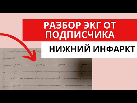 ECG Analysis by a Subscriber. Inferior Infarction? (ST-Segment Elevation Acute Coronary Syndrome)