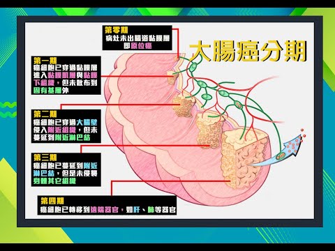 【名醫妙方】大腸癌的分期與其治療方式 2022.07.25