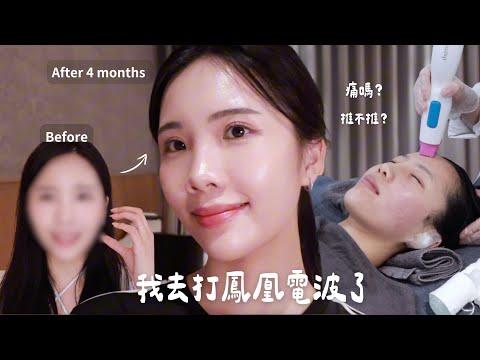 我去打鳳凰電波了❗️術後4個月心得分享✨電波/音波怎麼分?到底推不推?