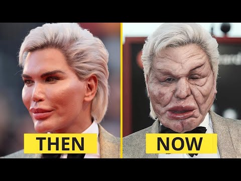 10 Celebrity Plastic Surgery Disasters You Won’t Believe Are Real 😱 | Then & Now 2025